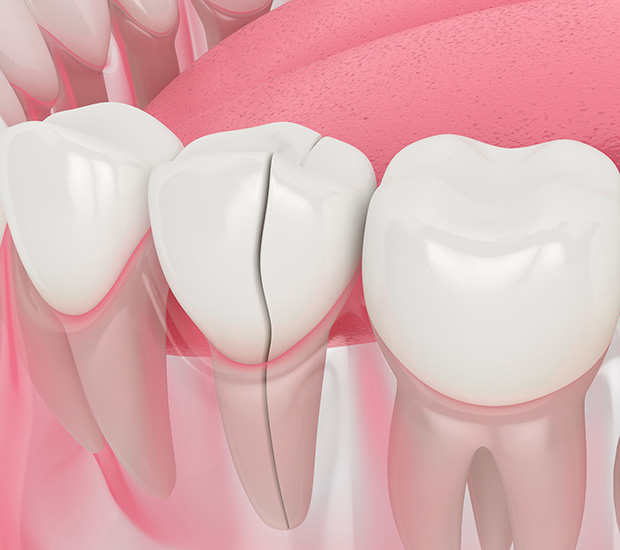 Dacula Types of Dental Root Fractures